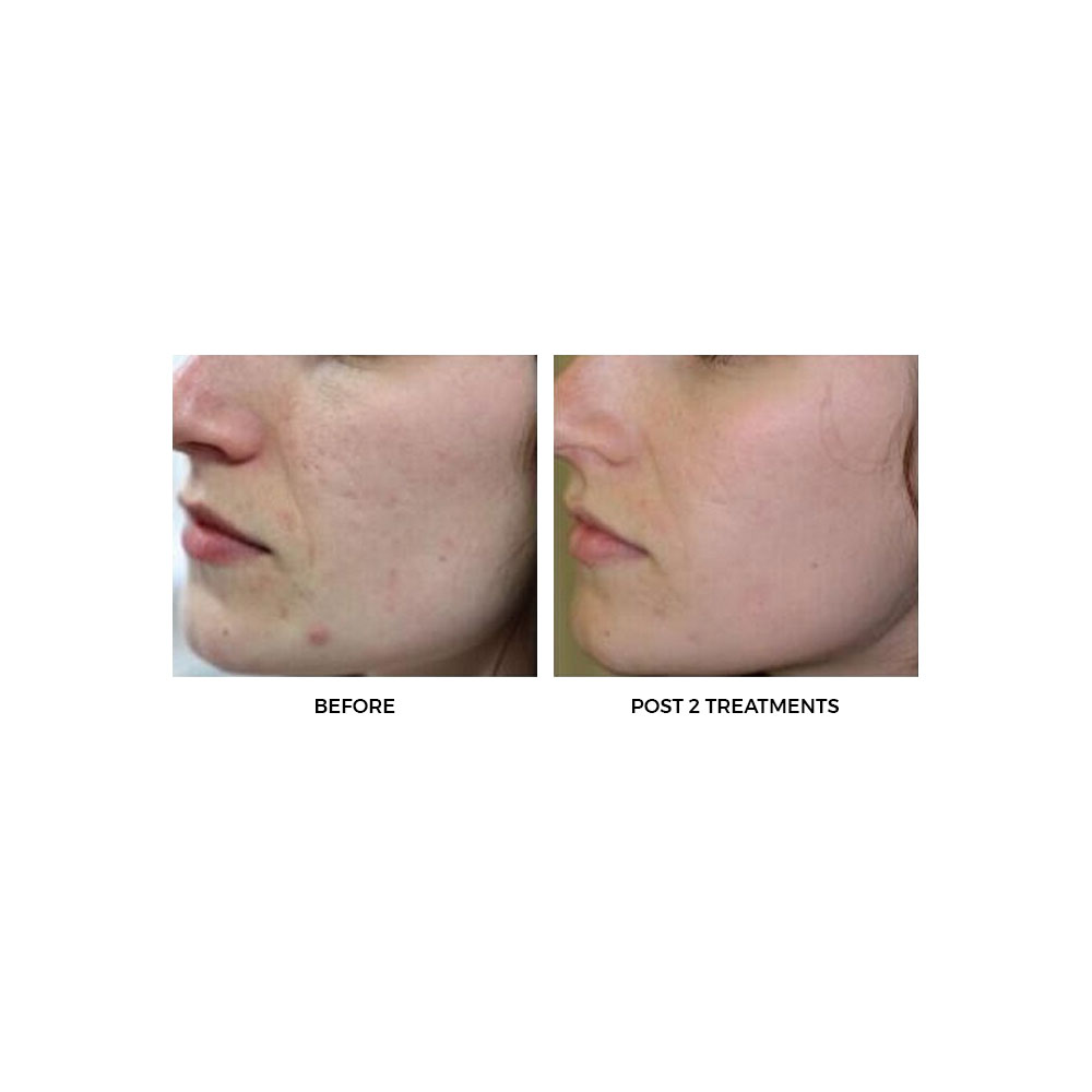 6 in 1 - Multi Functional Facial System w/ Oxygen - Image 6