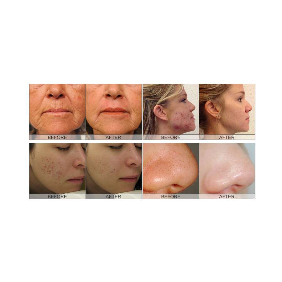 Advanced Hydra Dermabrasion Multifunction Machine (Table Top) - Image 9