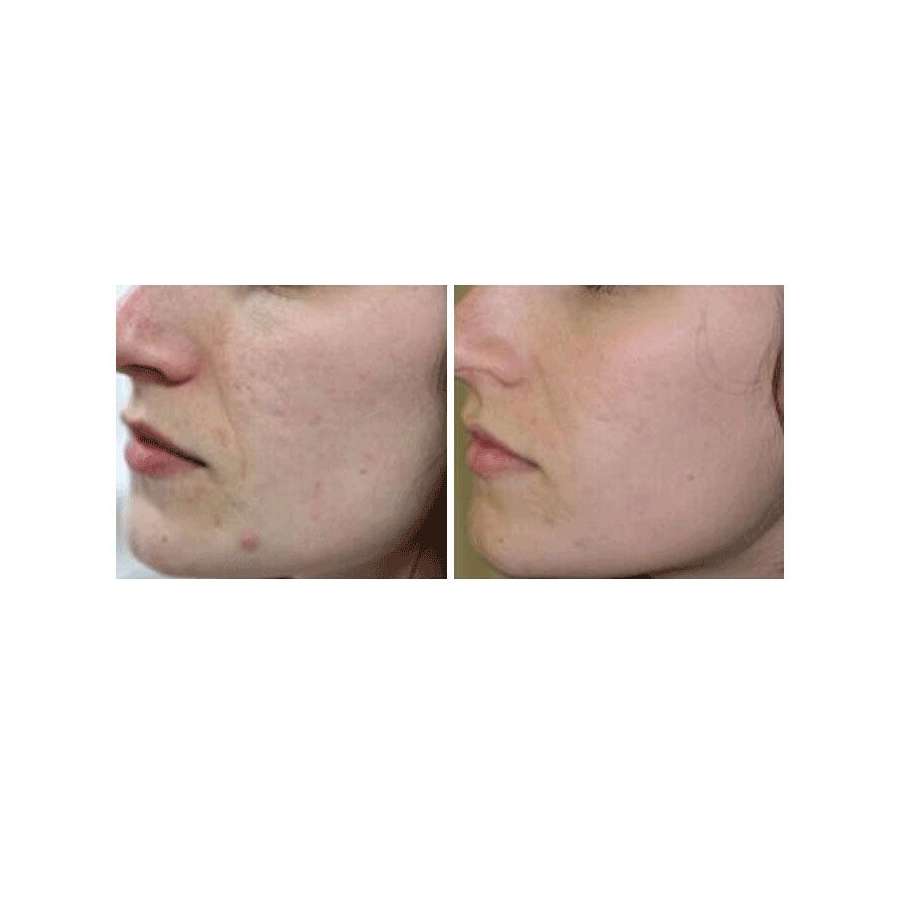 Advanced Hydra Dermabrasion Multifunction Machine (Table Top) - Image 10